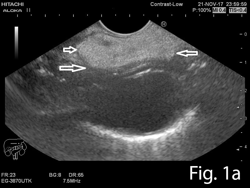 Large pedunculated lipoma of the esophagus: a case report </br> [Mar 2019]