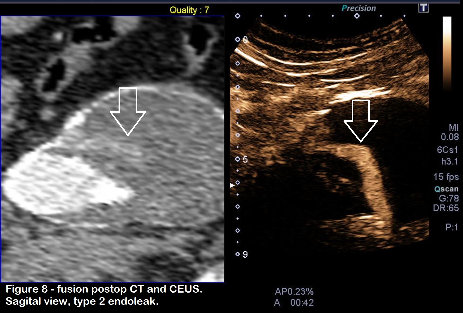 Post-EVAR control with CEUS and fusion-ultrasound </br> [Feb 2019]