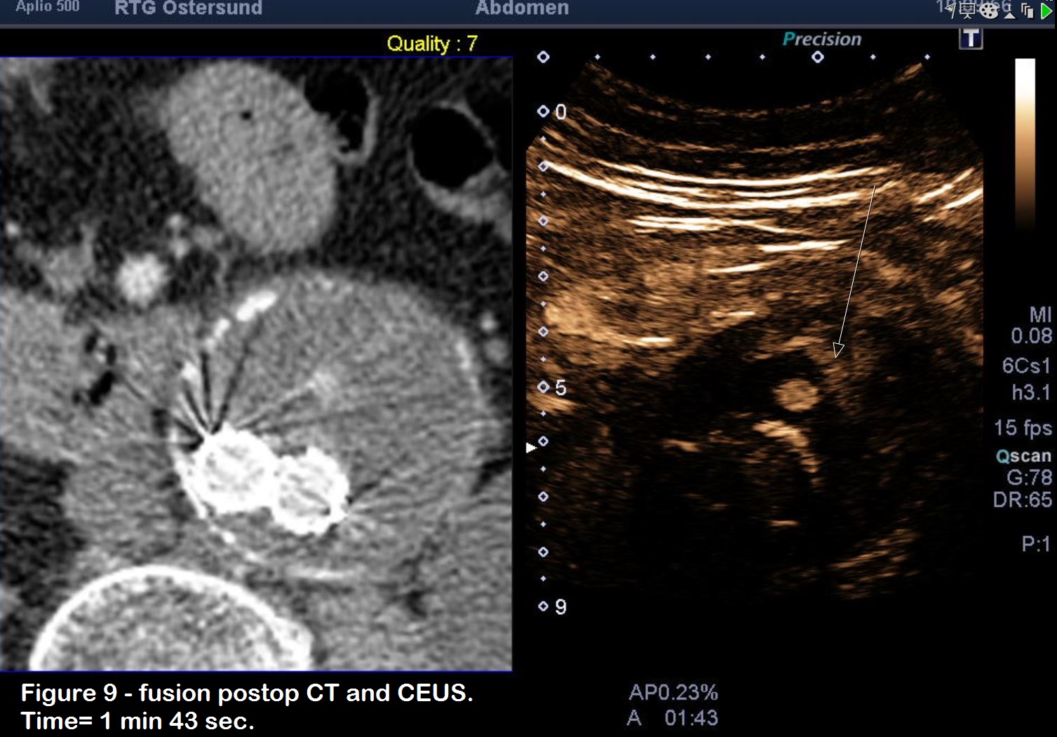 Post-EVAR control with CEUS and fusion-ultrasound </br> [Feb 2019]