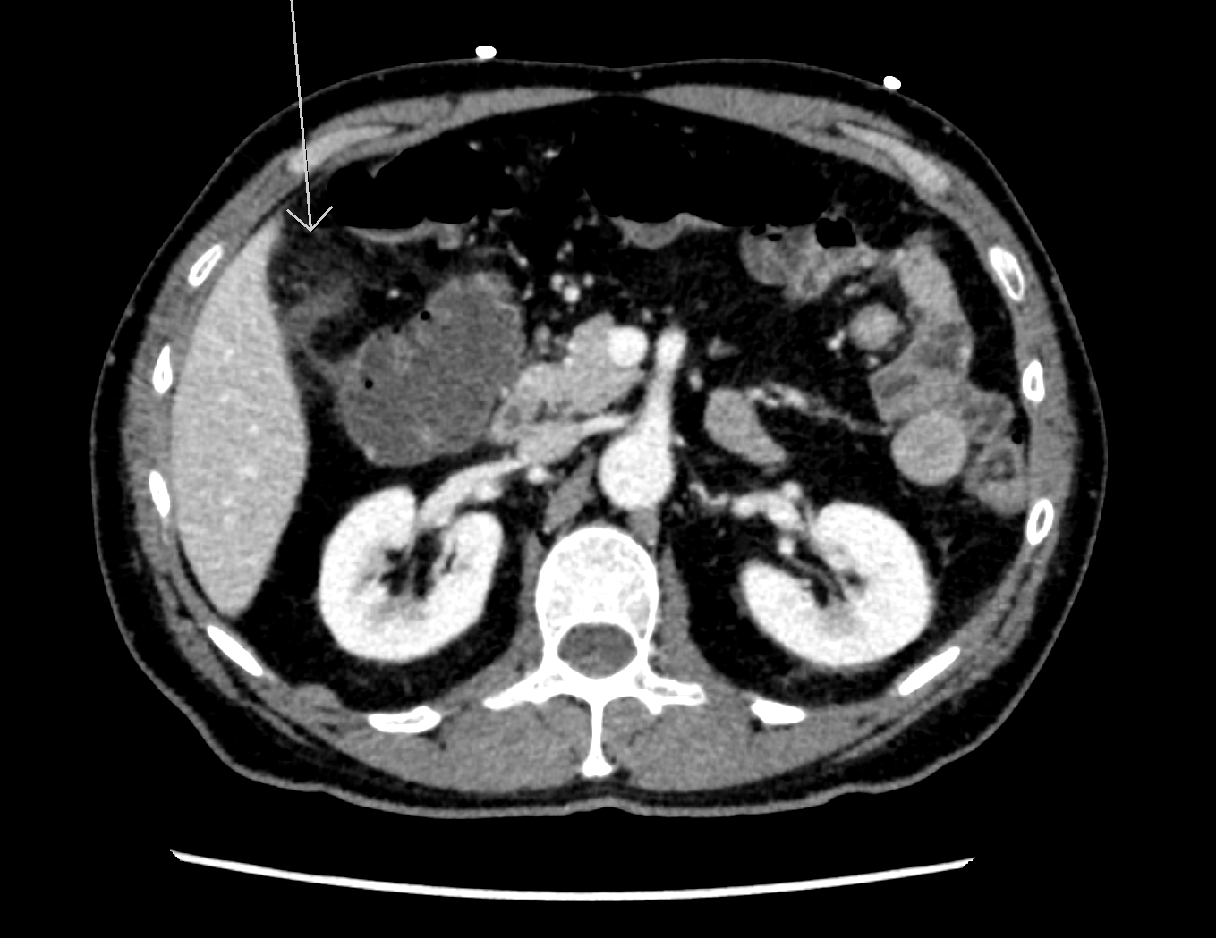 The role of clinical findings in a patient with acute abdominal pain </br> [Feb/Mar 2020]