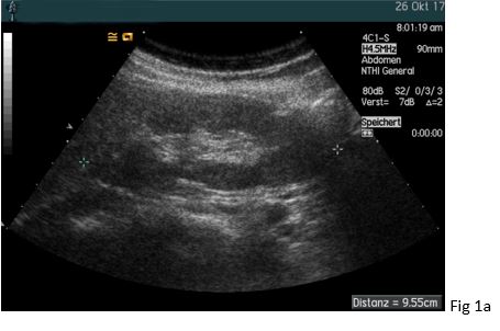Fibromuscular dysplasia of the right renal artery</br> [Dec 2017]