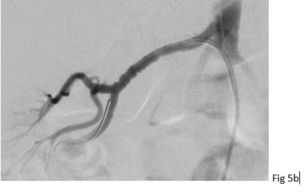 Fibromuscular dysplasia of the right renal artery</br> [Dec 2017]