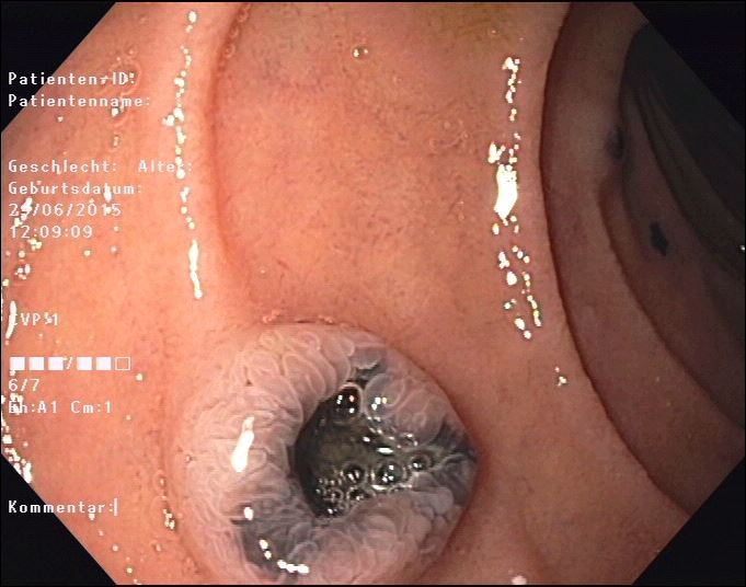 A rare tumor in the gallbladder mimicking sludge</br> [Jan 2017]