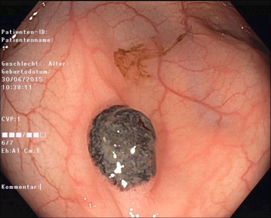 A rare tumor in the gallbladder mimicking sludge</br> [Jan 2017]