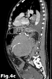 Scrotal varicocele in older patients: should we search for a renal tumour?</br> [Jul 2016]
