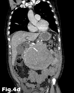 Scrotal varicocele in older patients: should we search for a renal tumour?</br> [Jul 2016]