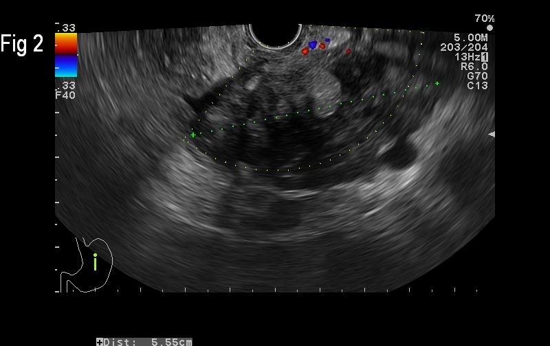 Cystic Liver Metastases of a Neuroendocrine Pancreatic Tumor</br> [Mar 2016]
