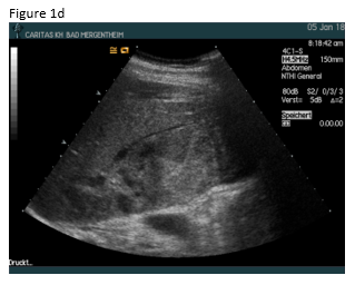 Pseudoaneurysm, a rare complication after liver abscess drainage</br> [Mar 2018]