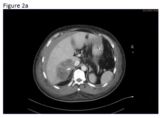 Pseudoaneurysm, a rare complication after liver abscess drainage</br> [Mar 2018]