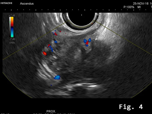 Endometriosis infiltrating the sigmoid colon</br> [May 2017]
