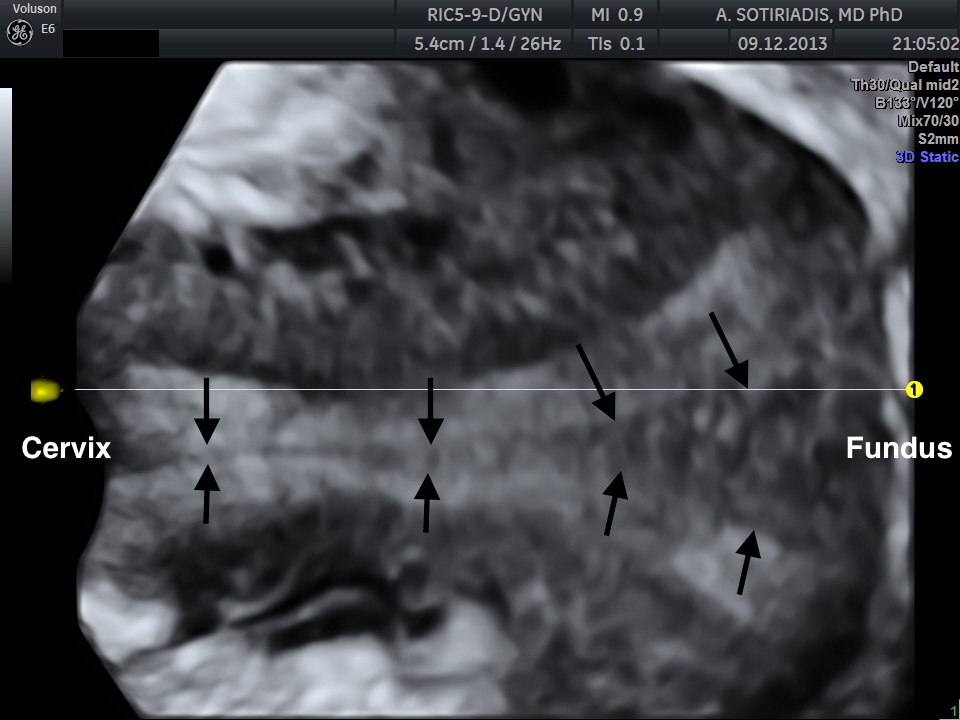 One-stop differential diagnosis of Mllerian anomalies using 3D ultrasound: complete uterine septum</br> [Nov 2016]