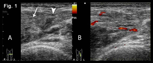 Bilateral quadriceps muscles and suprapatellar recesses injuries: ultrasound evaluation [Sep 2016]