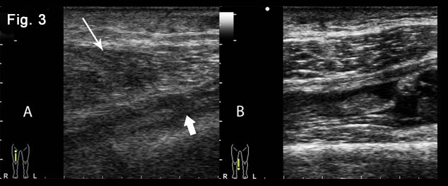 Bilateral quadriceps muscles and suprapatellar recesses injuries: ultrasound evaluation [Sep 2016]