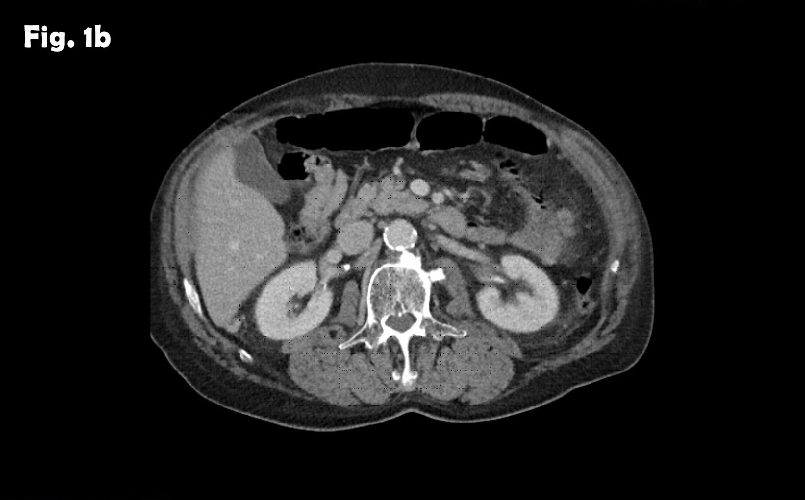 Splenosis mimicking peritoneal metastasis</br> [Sep 2017]