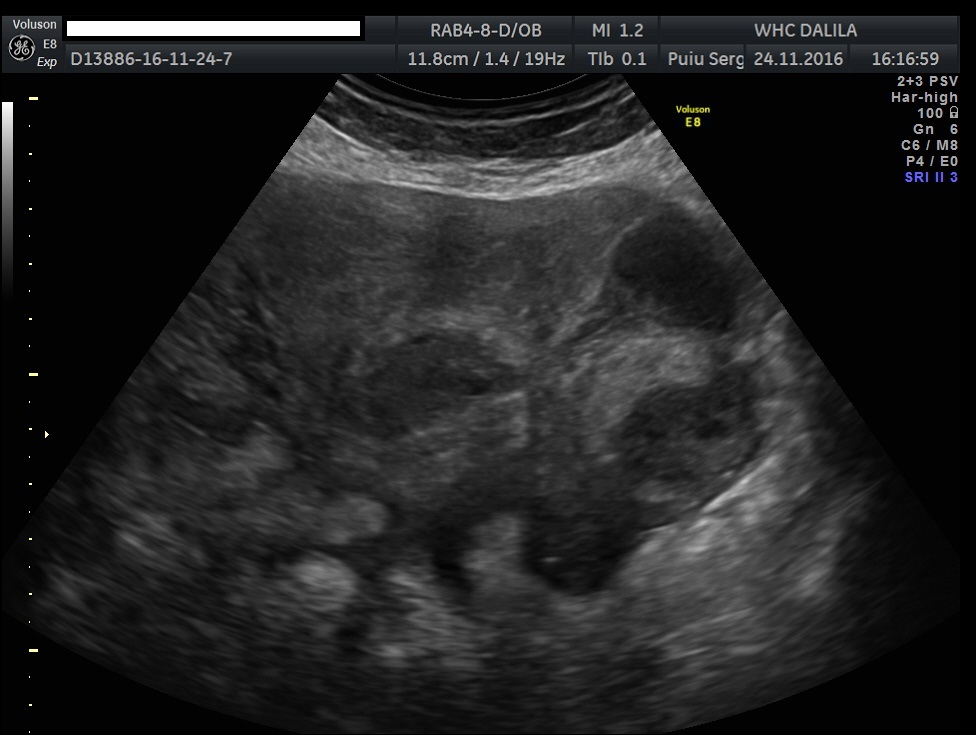 Unusual case of uterine perforation by a tubo-ovarian abscess </br> [Sep 2018]