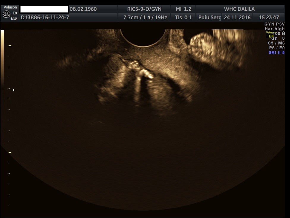 Unusual case of uterine perforation by a tubo-ovarian abscess </br> [Sep 2018]