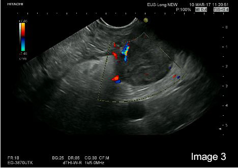 Multimodal endoscopic ultrasound of a woman with multiple pancreatic lesions</br> [Oct 2017]