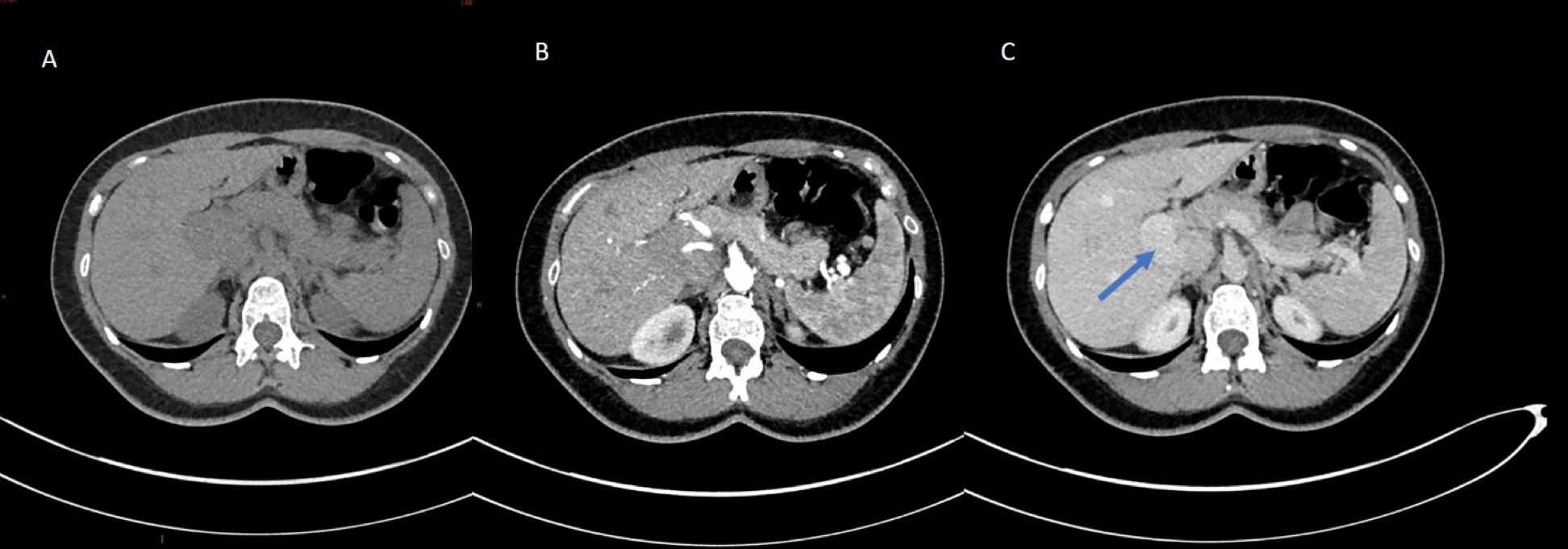 Congenital porto-systemic shunt as a cause of elevated manganese in adults </br> [Oct/Nov 2020]
