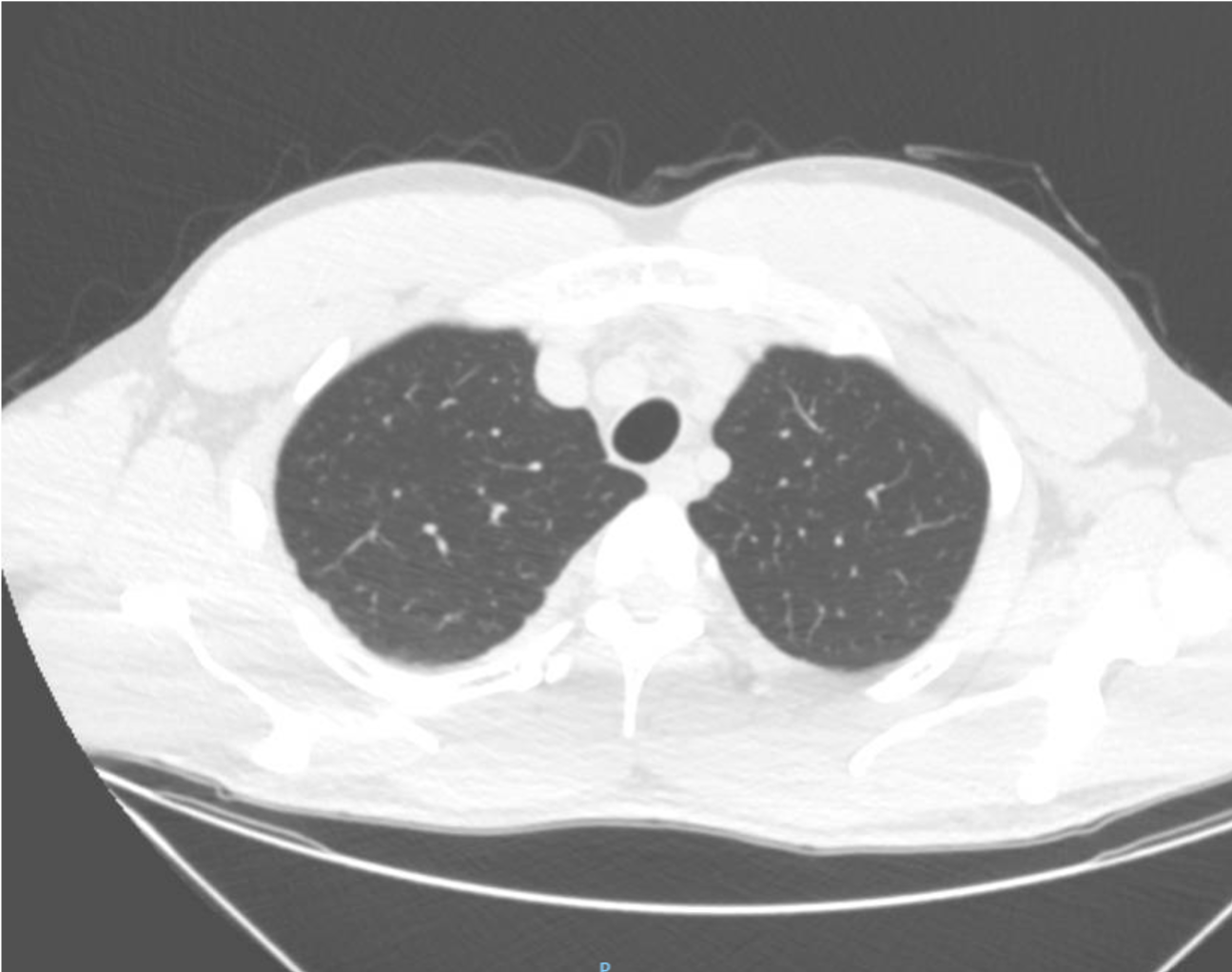 Ultrasound findings in COVID-19 pneumonia </br> [Apr 2020]