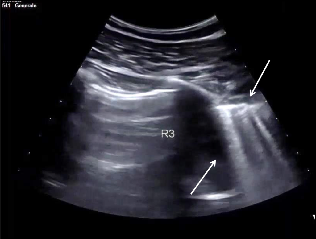 Ultrasound findings in COVID-19 pneumonia </br> [Apr 2020]