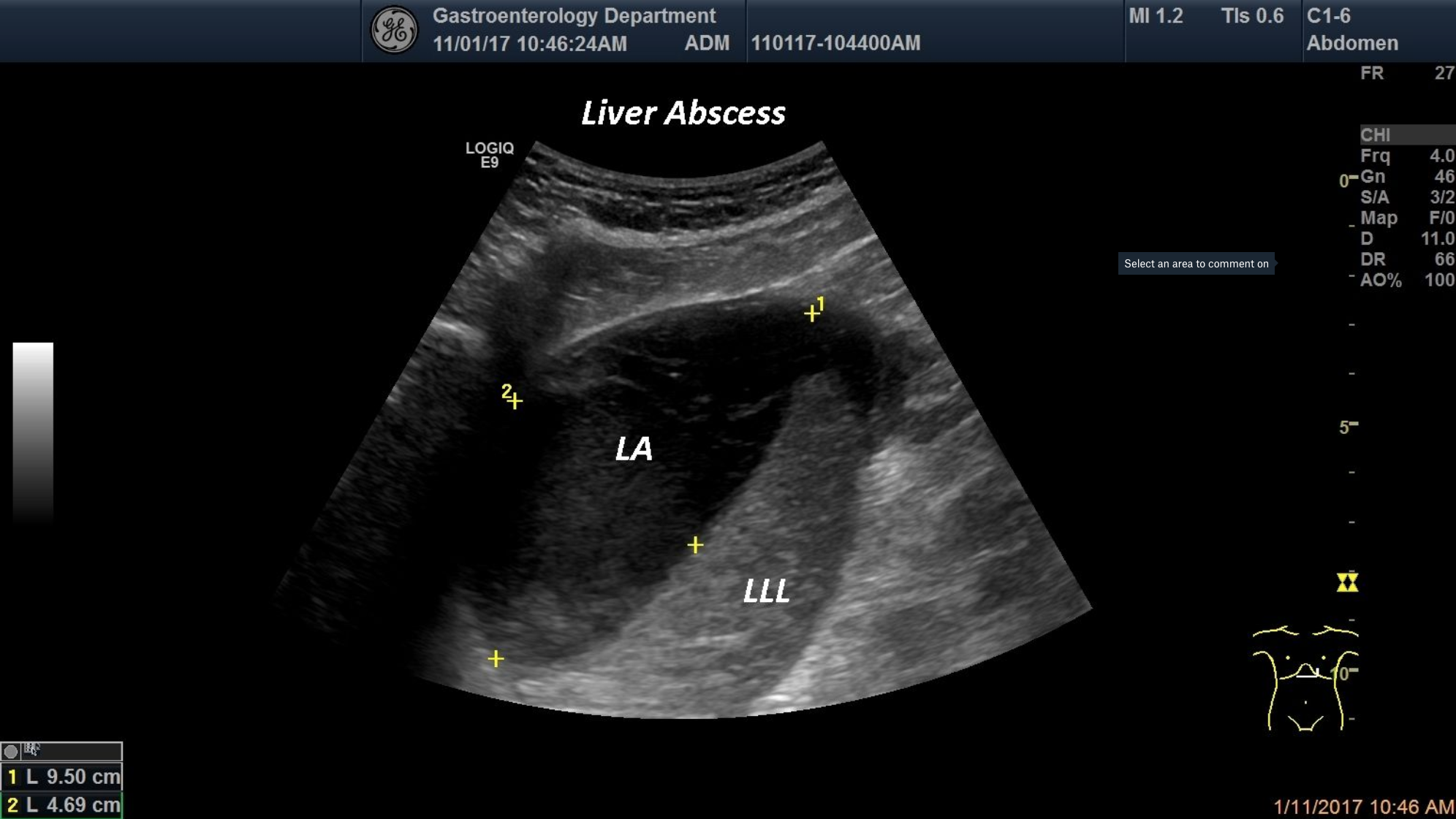Liver Abscess [1 image]
