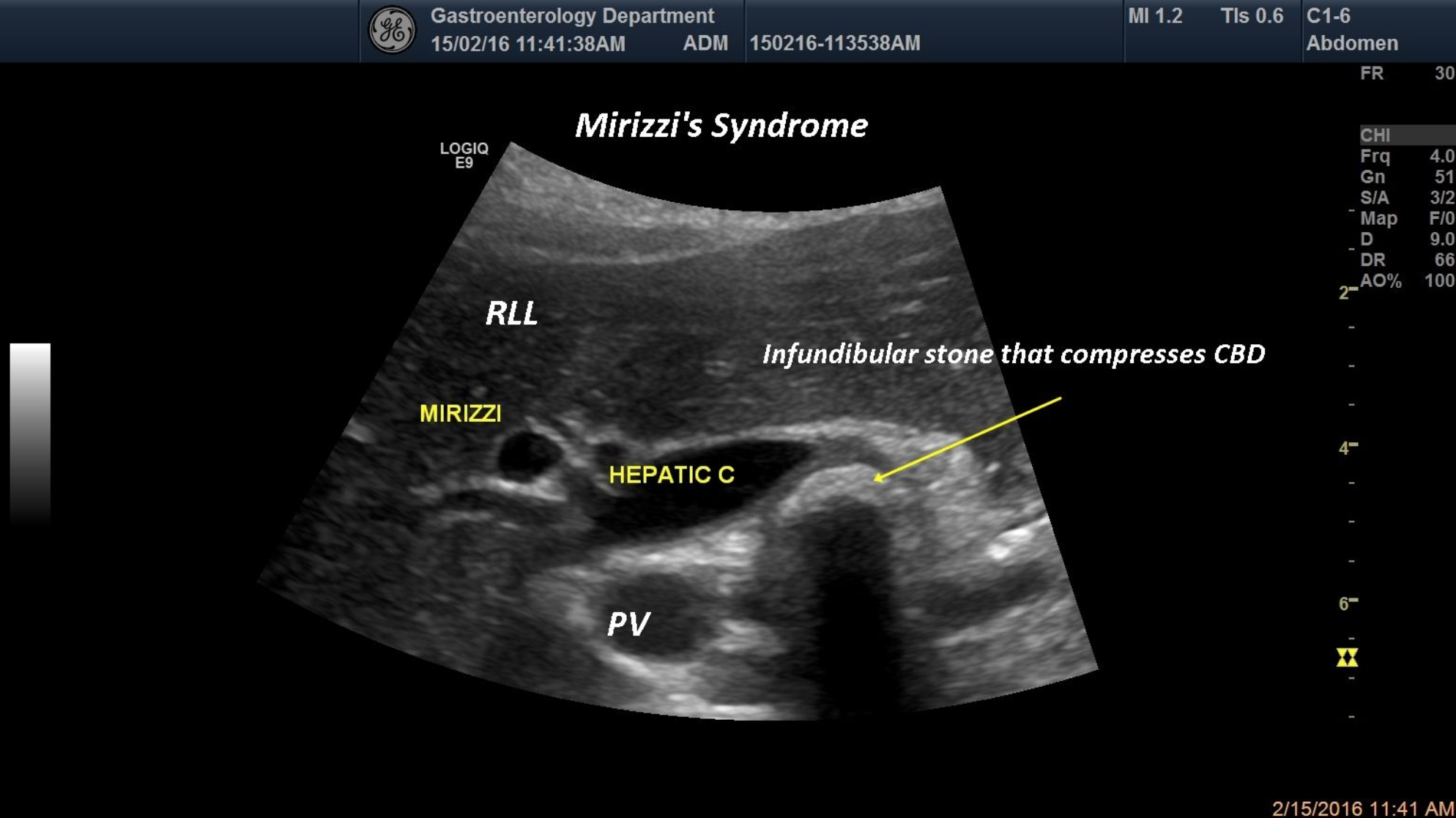 Mirizzi syndrome [1 image]