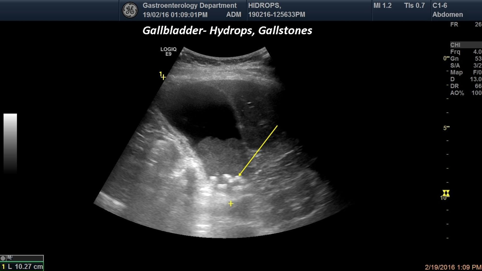 Gallbladder Hydrops, Gallstones and sludge [1 image]