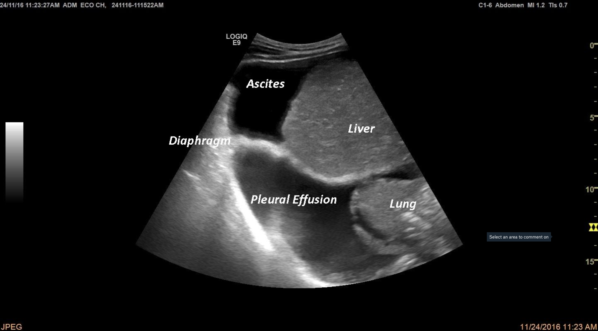 Ascites and Pleural Effusion in a cirrhotic patient [1 image]