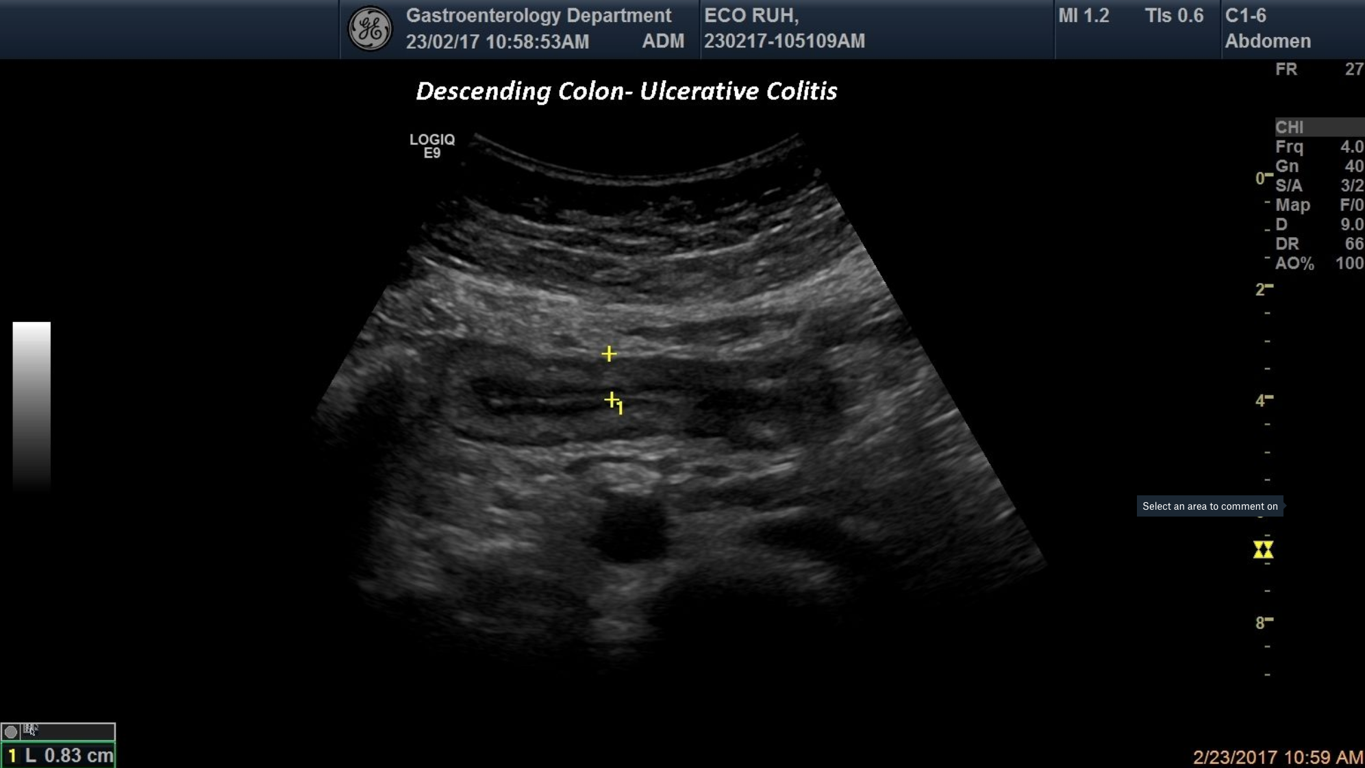 Ulcerative colitis-descending colon [1 image]