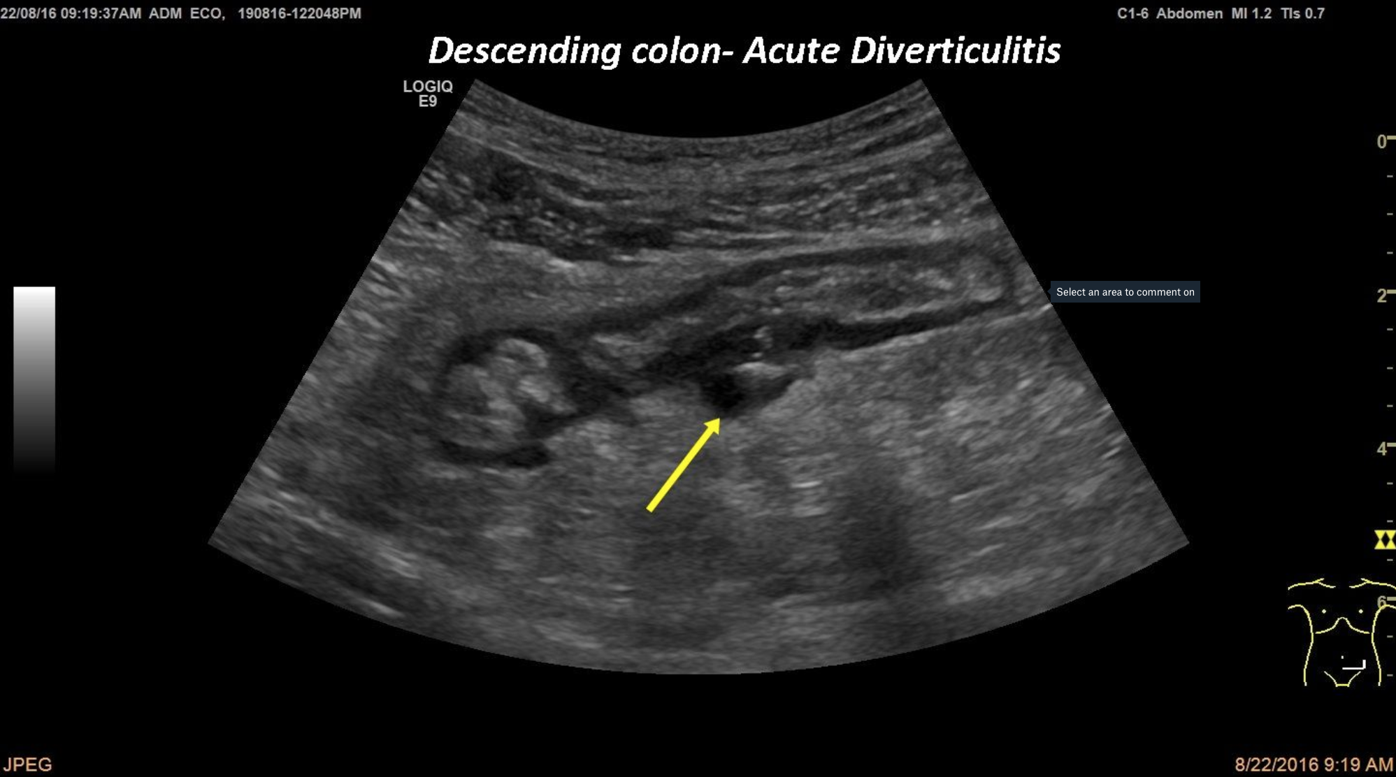 Acute Diverticulitis [1 image]