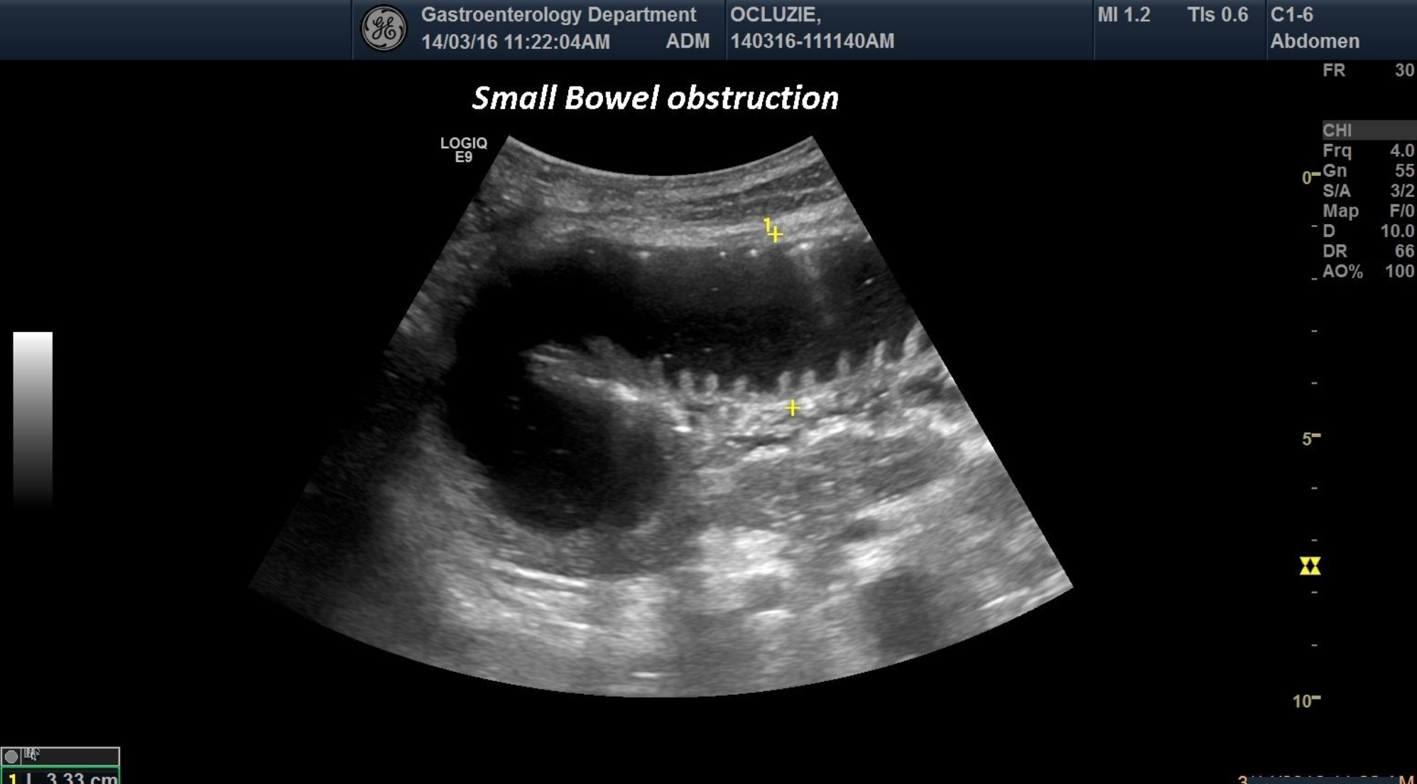 Small bowel obstruction [1 image]