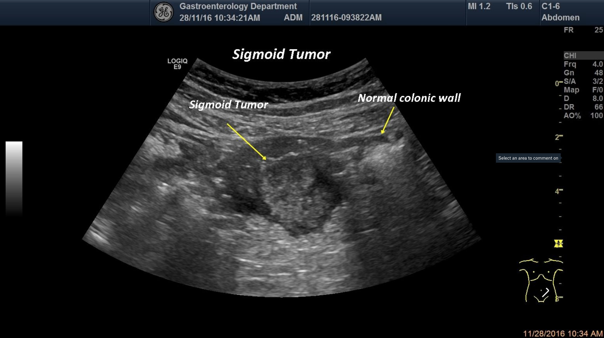 Sigmoid tumor [1 image]