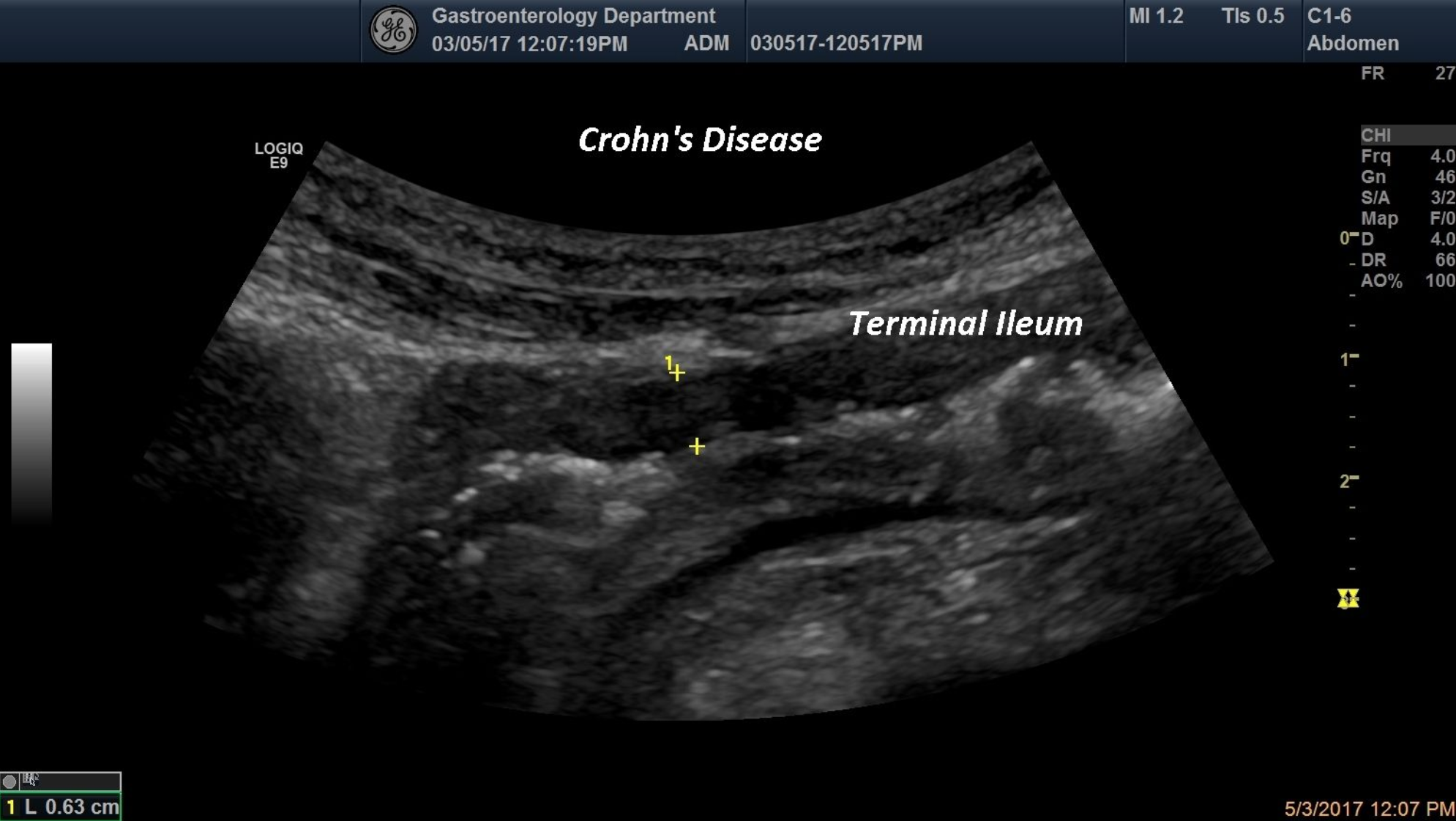 Crohn’s Disease [1 image]
