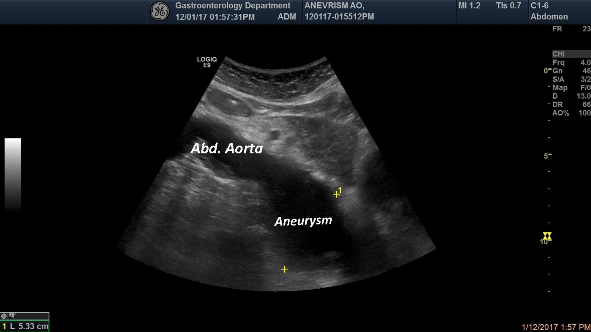 Abdominal Aorta Aneurysm [1 image]