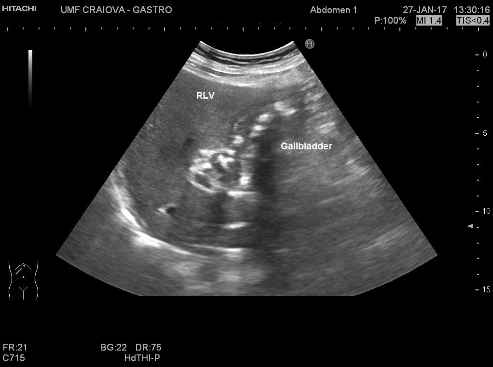 Gallbladder carcinoma [1 image]