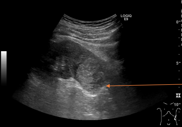 The Role Of Ultrasound In Detection And Characterisation Of Incidental