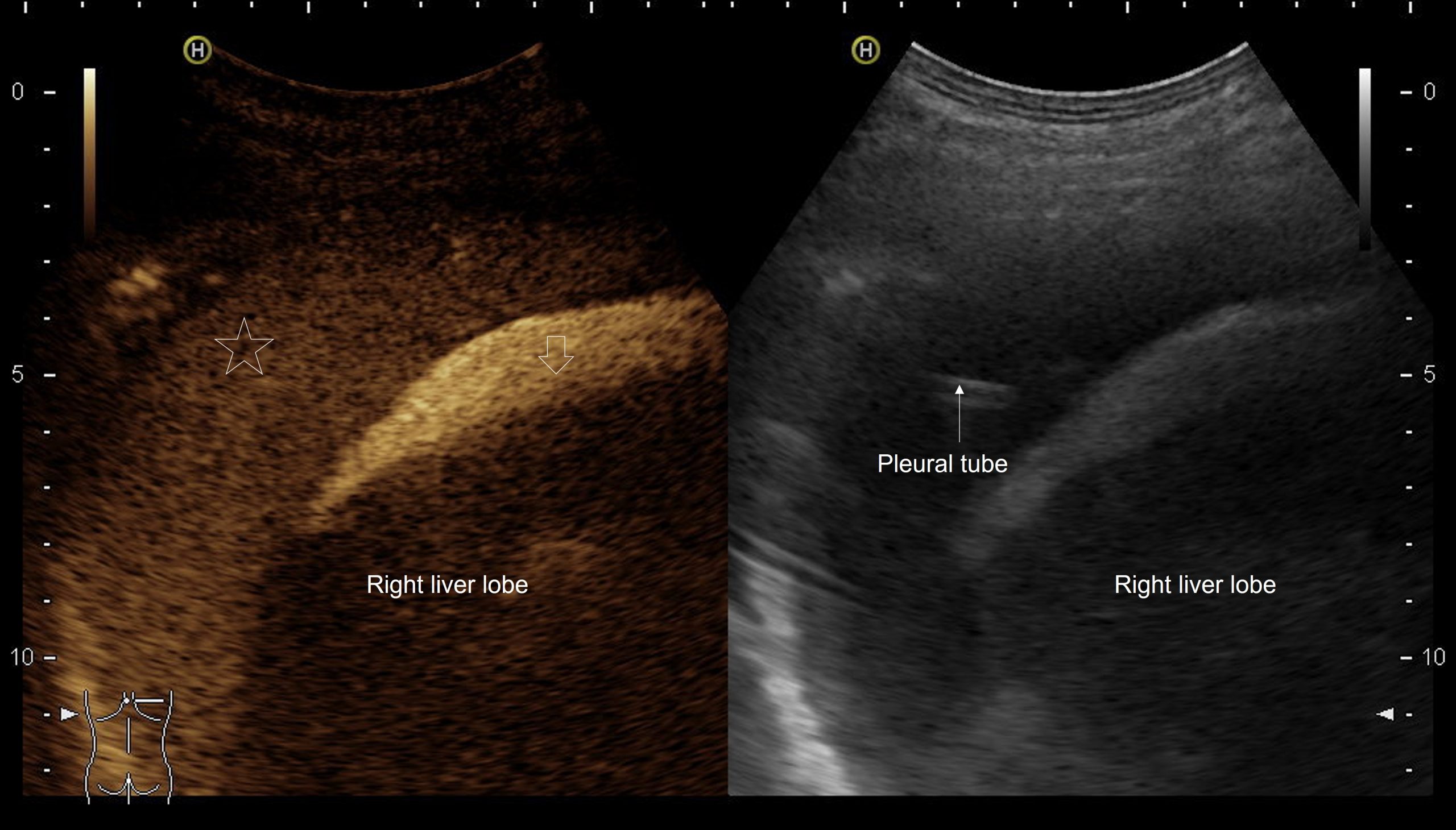 Direct proof of hepatic hydrothorax by intracavitary contrast-enhanced ultrasound </br> [Mar 2022]