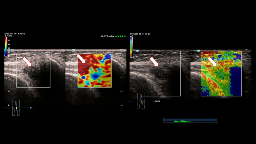 Giant cell tumor with additional synovial proliferations [April 2023 ...