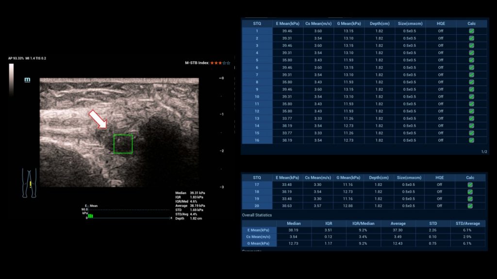 Giant cell tumor with additional synovial proliferations [April 2023 ...